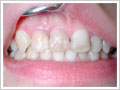 ホワイトニング術前（失活歯） (2)
