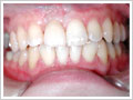 前歯部1歯欠損術後